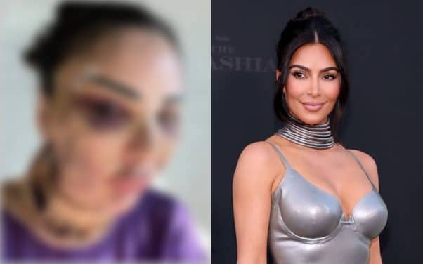 600 000 euros pour ressembler à Kim Kardashian : une influenceuse en dépense 120 000 pour tout enlever