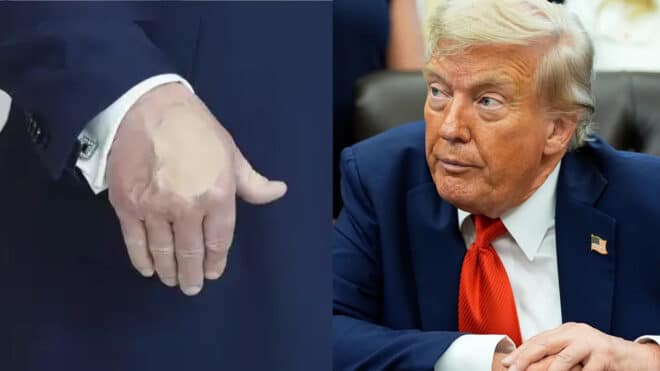 Donald Trump : un problème de santé derrière sa mystérieuse tâche à la main ?